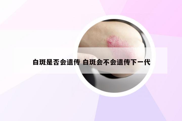 白斑是否会遗传 白斑会不会遗传下一代