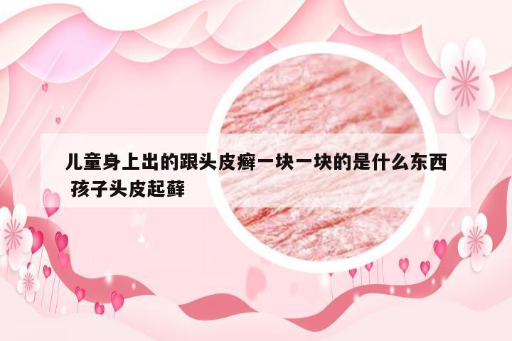 儿童身上出的跟头皮癣一块一块的是什么东西 孩子头皮起藓
