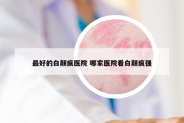最好的白颠疯医院 哪家医院看白颠疯强