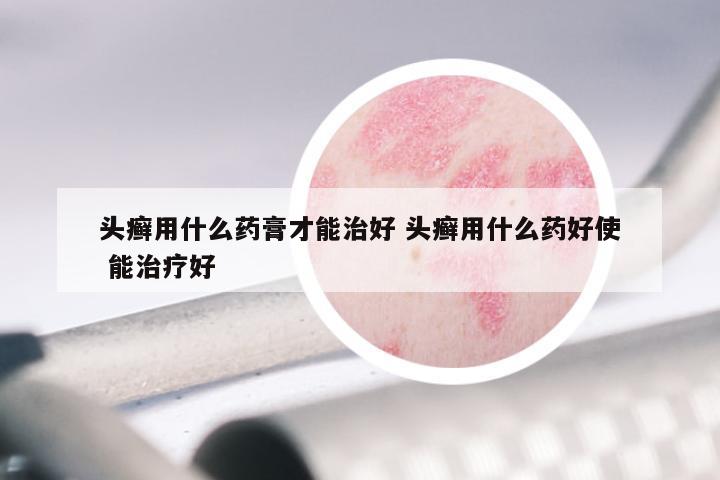 头癣用什么药膏才能治好 头癣用什么药好使 能治疗好