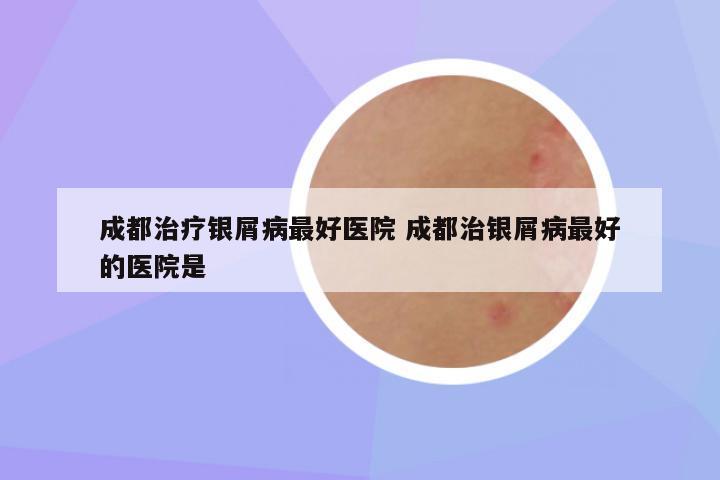 成都治疗银屑病最好医院 成都治银屑病最好的医院是