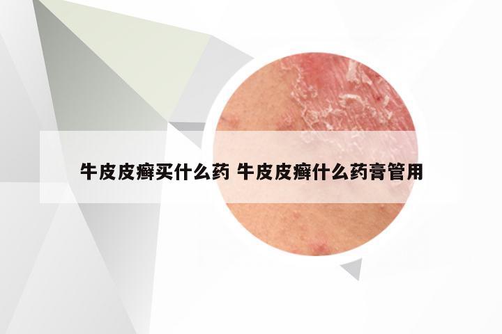 牛皮皮癣买什么药 牛皮皮癣什么药膏管用