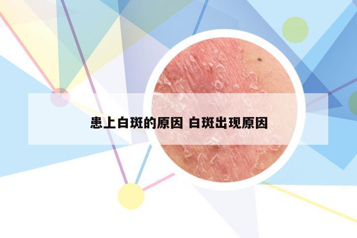 患上白斑的原因 白斑出现原因