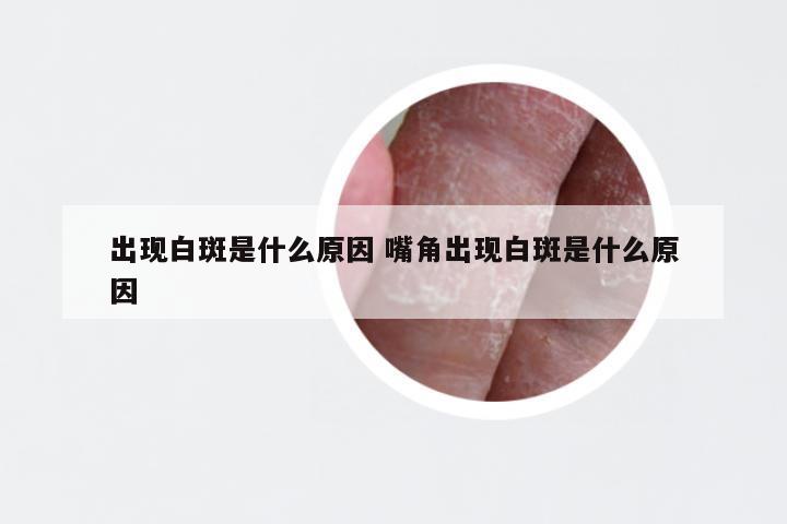 出现白斑是什么原因 嘴角出现白斑是什么原因