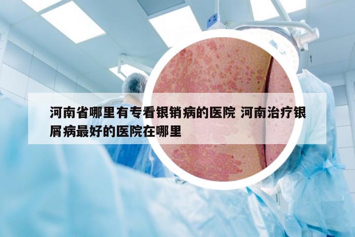 河南省哪里有专看银销病的医院 河南治疗银屑病最好的医院在哪里