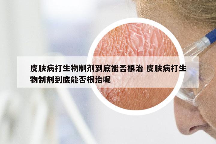 皮肤病打生物制剂到底能否根治 皮肤病打生物制剂到底能否根治呢