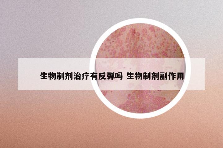 生物制剂治疗有反弹吗 生物制剂副作用