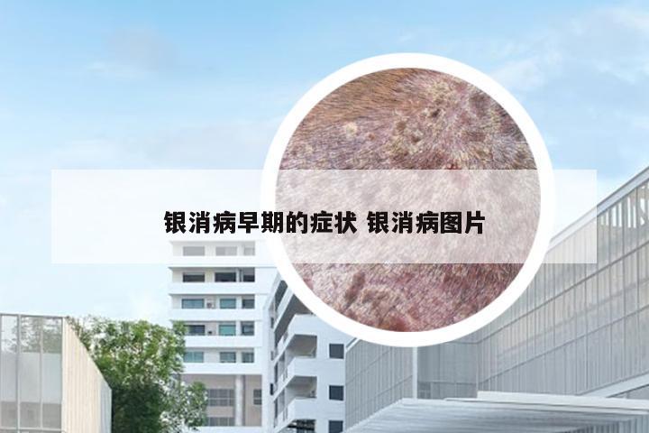 银消病早期的症状 银消病图片