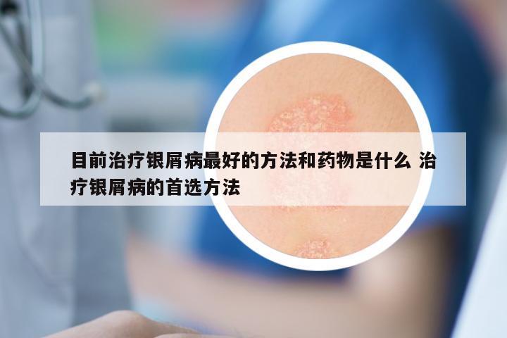 目前治疗银屑病最好的方法和药物是什么 治疗银屑病的首选方法