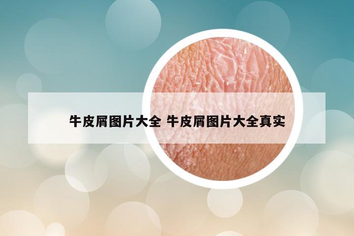 牛皮屑图片大全 牛皮屑图片大全真实