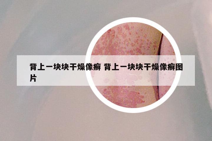 背上一块块干燥像癣 背上一块块干燥像癣图片