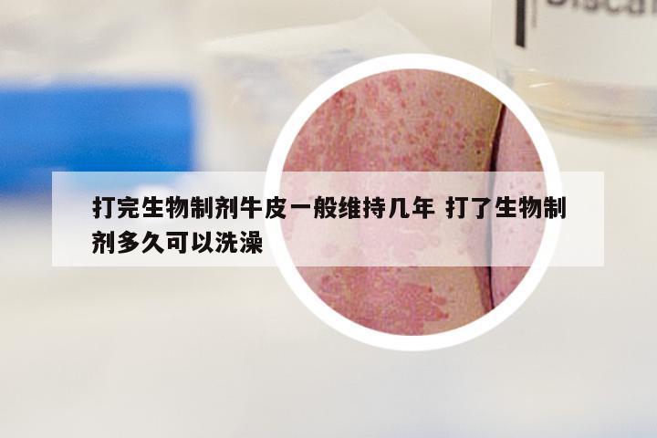 打完生物制剂牛皮一般维持几年 打了生物制剂多久可以洗澡