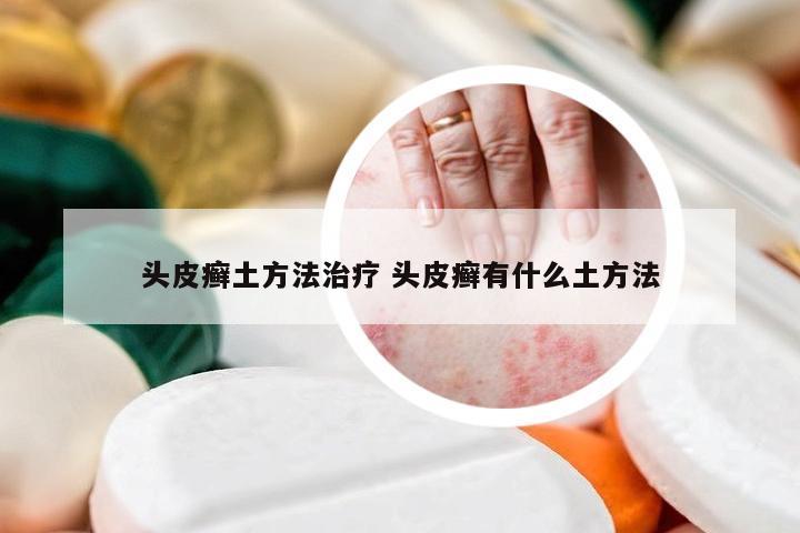 头皮癣土方法治疗 头皮癣有什么土方法