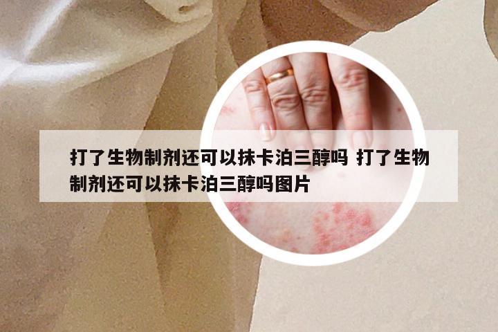 打了生物制剂还可以抹卡泊三醇吗 打了生物制剂还可以抹卡泊三醇吗图片