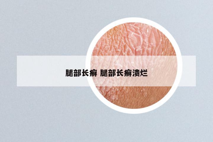 腿部长癣 腿部长癣溃烂