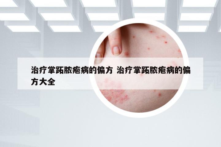 治疗掌跖脓疱病的偏方 治疗掌跖脓疱病的偏方大全