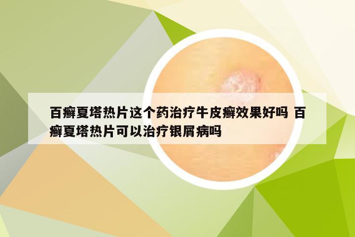 百癣夏塔热片这个药治疗牛皮癣效果好吗 百癣夏塔热片可以治疗银屑病吗