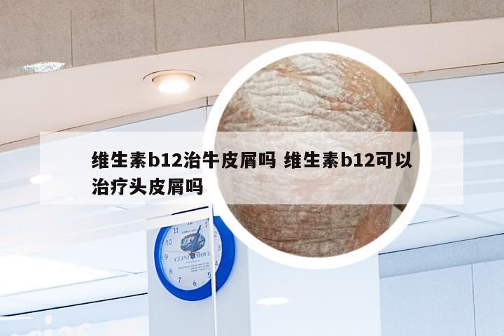 维生素b12治牛皮屑吗 维生素b12可以治疗头皮屑吗