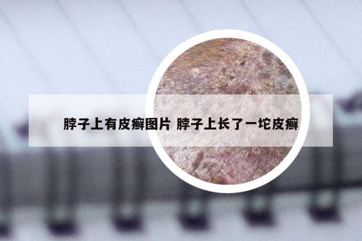 脖子上有皮癣图片 脖子上长了一坨皮癣