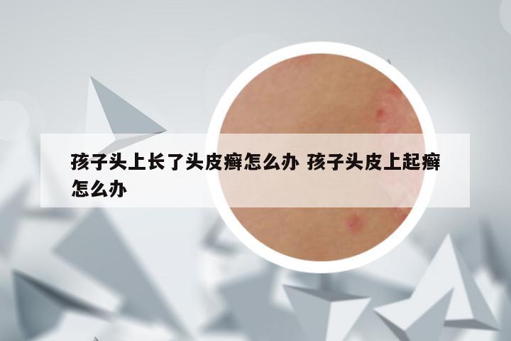 孩子头上长了头皮癣怎么办 孩子头皮上起癣怎么办