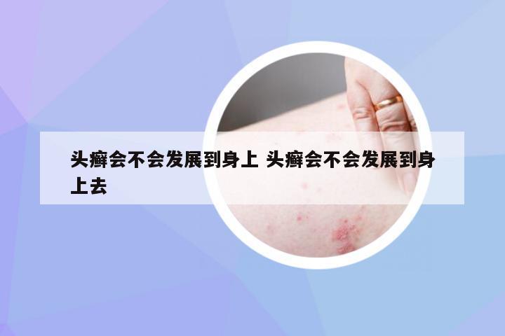 头癣会不会发展到身上 头癣会不会发展到身上去