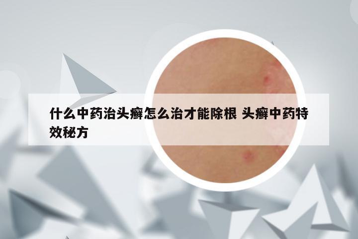 什么中药治头癣怎么治才能除根 头癣中药特效秘方