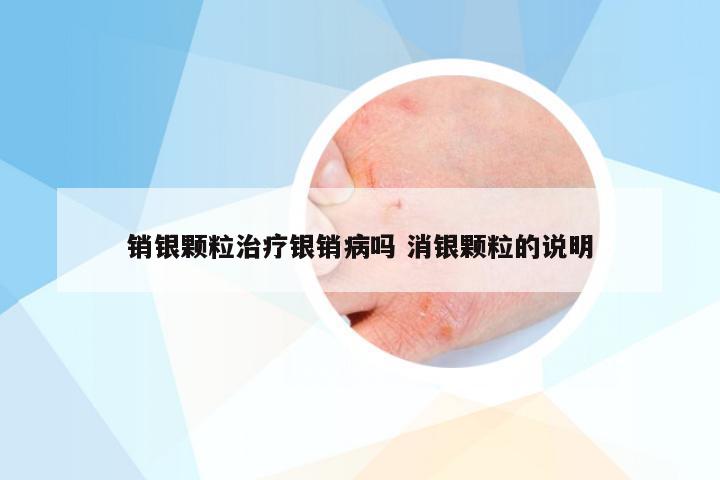 销银颗粒治疗银销病吗 消银颗粒的说明