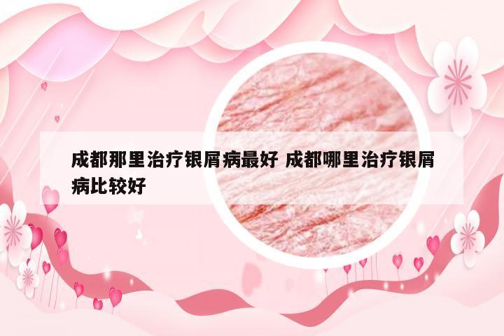 成都那里治疗银屑病最好 成都哪里治疗银屑病比较好
