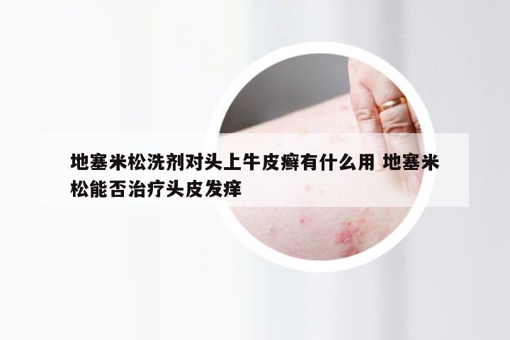 地塞米松洗剂对头上牛皮癣有什么用 地塞米松能否治疗头皮发痒