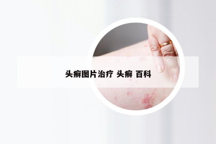 头癣图片治疗 头癣 百科