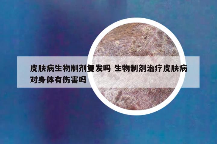 皮肤病生物制剂复发吗 生物制剂治疗皮肤病对身体有伤害吗