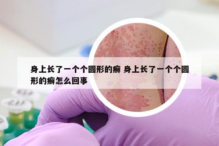 身上长了一个个圆形的癣 身上长了一个个圆形的癣怎么回事
