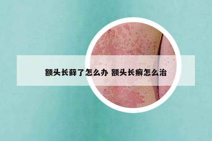 额头长藓了怎么办 额头长癣怎么治