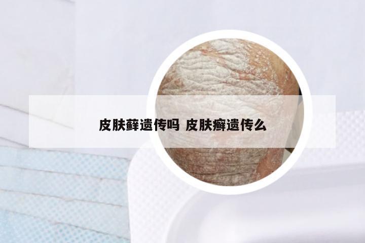 皮肤藓遗传吗 皮肤癣遗传么