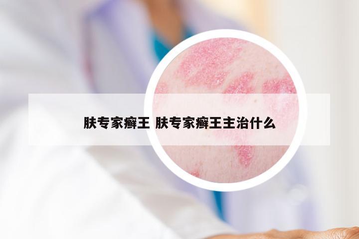 肤专家癣王 肤专家癣王主治什么