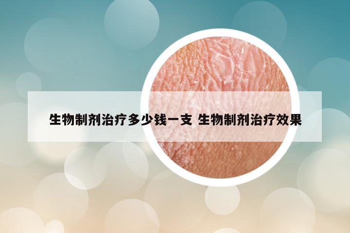生物制剂治疗多少钱一支 生物制剂治疗效果