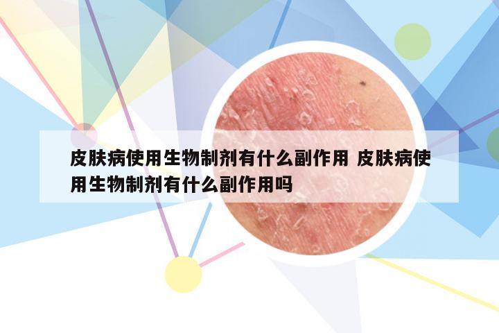 皮肤病使用生物制剂有什么副作用 皮肤病使用生物制剂有什么副作用吗