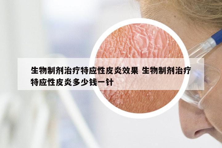 生物制剂治疗特应性皮炎效果 生物制剂治疗特应性皮炎多少钱一针