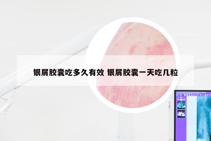 银屑胶囊吃多久有效 银屑胶囊一天吃几粒