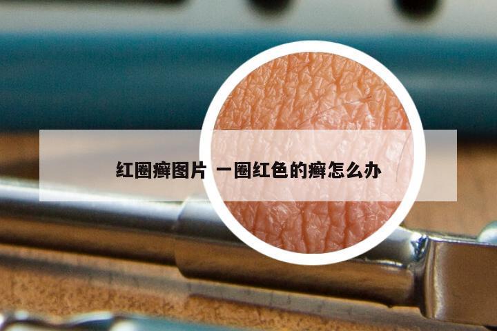 红圈癣图片 一圈红色的癣怎么办