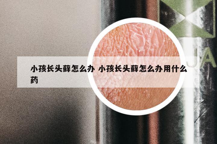 小孩长头藓怎么办 小孩长头藓怎么办用什么药