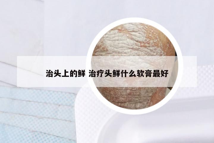 治头上的鲜 治疗头鲜什么软膏最好