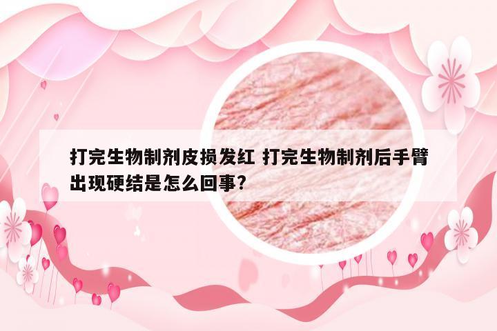 打完生物制剂皮损发红 打完生物制剂后手臂出现硬结是怎么回事?