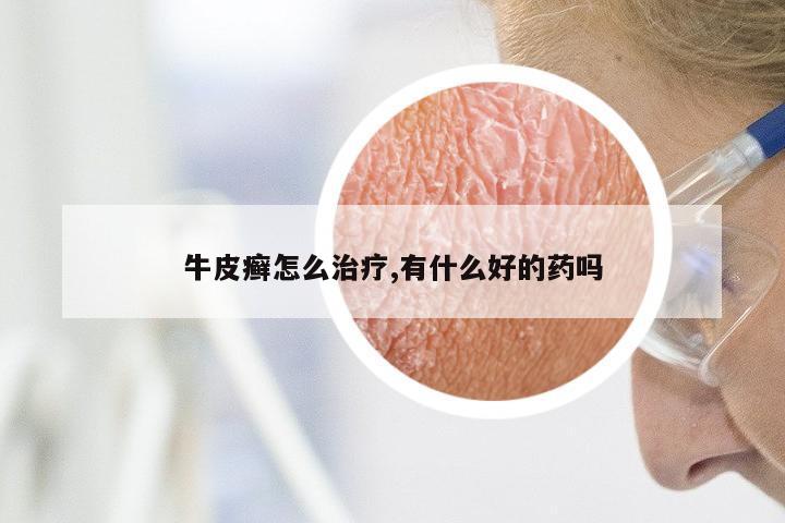 牛皮癣怎么治疗,有什么好的药吗