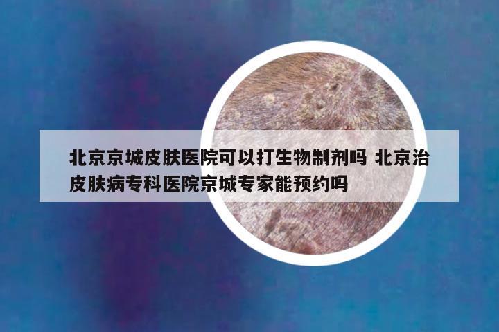 北京京城皮肤医院可以打生物制剂吗 北京治皮肤病专科医院京城专家能预约吗