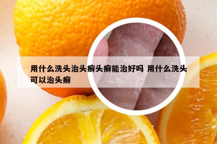 用什么洗头治头癣头癣能治好吗 用什么洗头可以治头癣