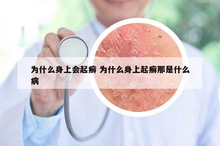 为什么身上会起癣 为什么身上起癣那是什么病