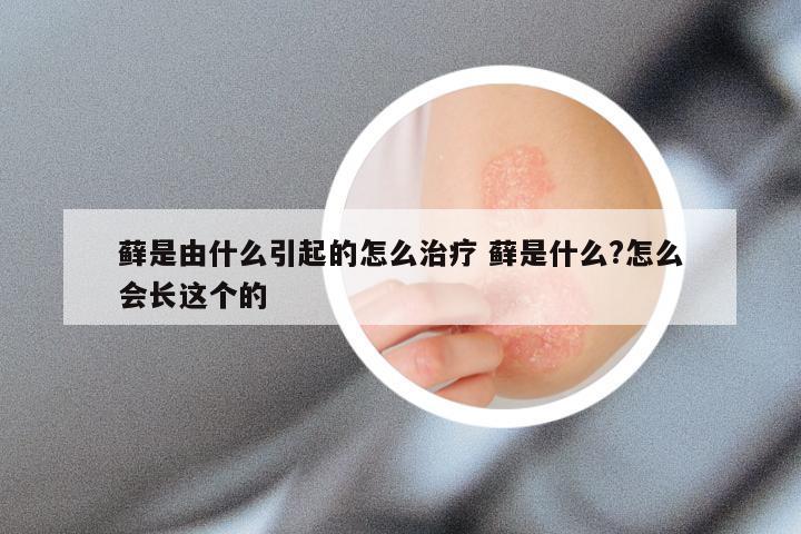 藓是由什么引起的怎么治疗 藓是什么?怎么会长这个的
