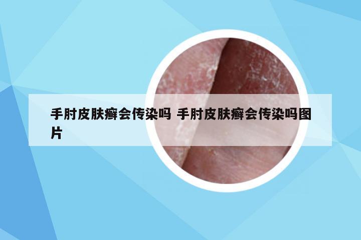 手肘皮肤癣会传染吗 手肘皮肤癣会传染吗图片