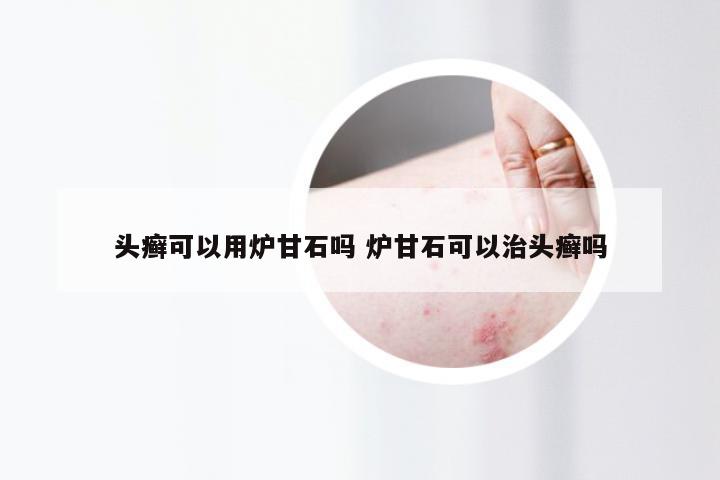 头癣可以用炉甘石吗 炉甘石可以治头癣吗
